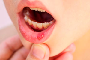 Афты - болезненные язвы во рту: причины и лечение